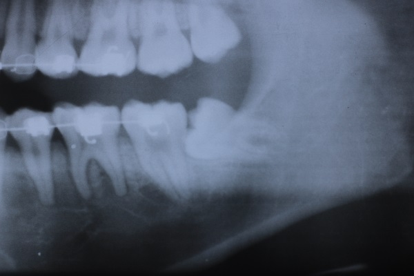 Case15