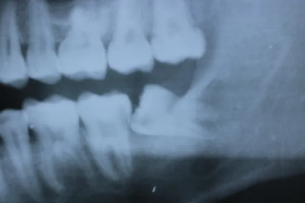 Case11