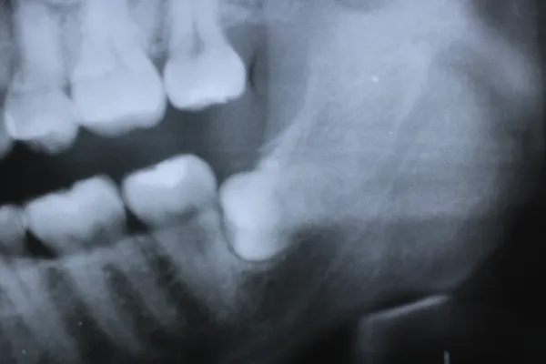 Case13