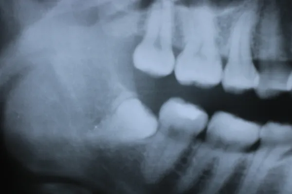 Case14